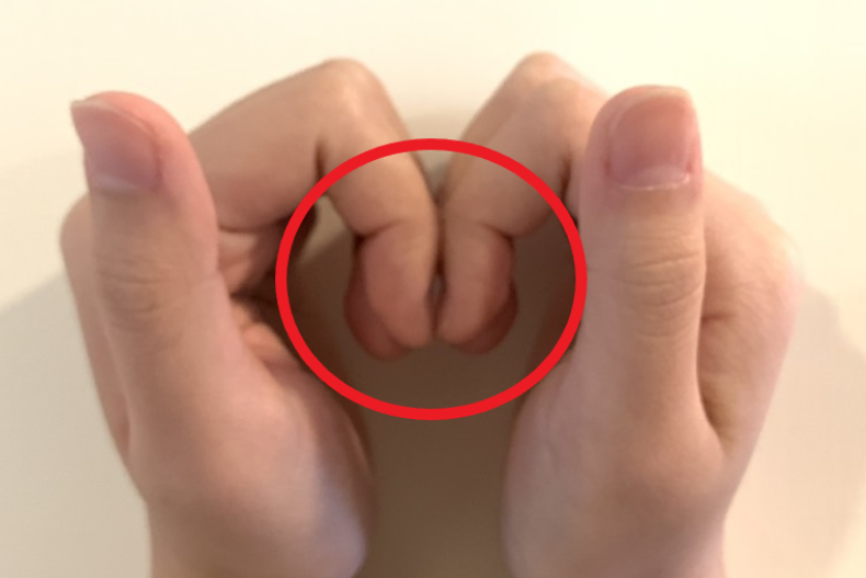 「手指腫起」半年肺癌去世！快伸手指檢測「杵狀指」症狀，無縫快就醫