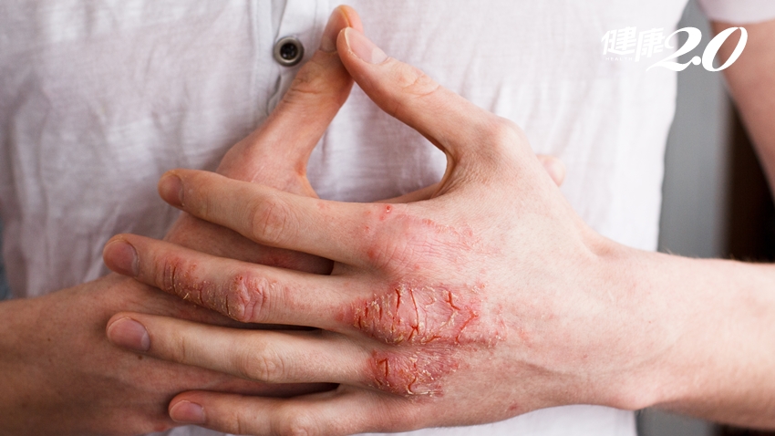 異位性皮膚炎總是時好時壞？6個小問題快速掌握病情