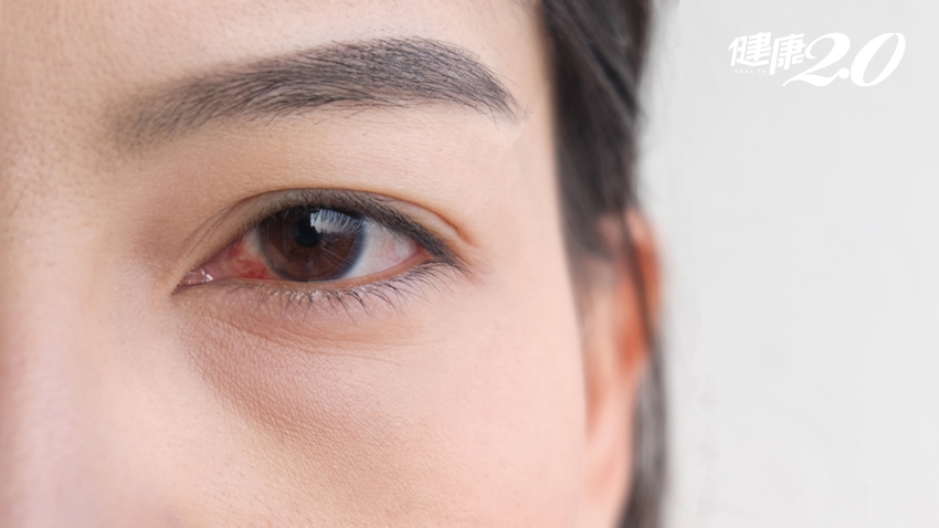 為什麼冬天好發乾眼症？3個好習慣改善眼睛乾澀疲勞、預防乾眼症