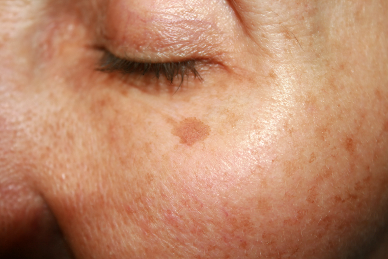 臉上斑點長不停？皮膚專家親曝「斑點類型、預防方法」：錯誤保養只會讓斑點更惡化