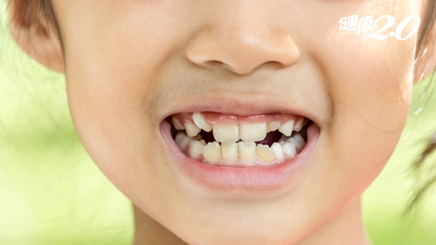 小孩「牙齒亂」不一定是長歪了！小心「1種疾病」影響臉部骨骼發育