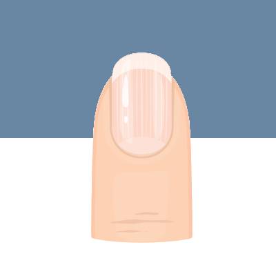 指甲出現黑直紋，小心是皮膚癌？從6種「指甲狀態」看懂身體健康
