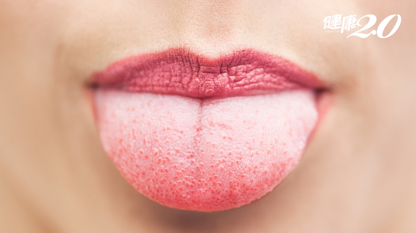 5種舌苔狀態看脾胃健康！這種顏色代表消化順暢、胃氣正合適