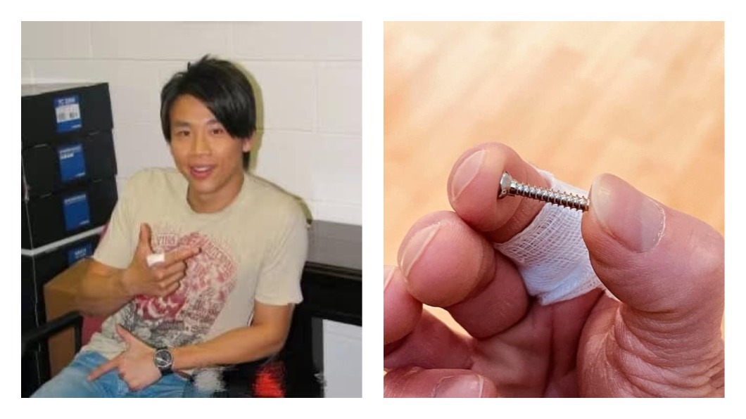 陶喆最近將15年前因摔車手指骨折所打的鋼釘取出。（圖片來源/ 取自陶喆臉書）