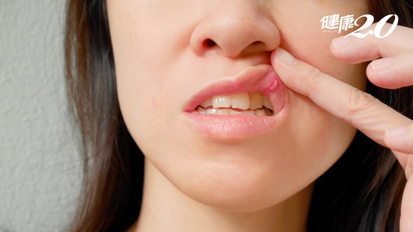 「嘴破」多吃奇異果有效？幫助黏膜修復，營養師教你吃「這3種」好得快