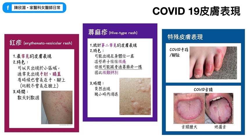 小心皮膚疹也是COVID-19症狀！醫曝尤其手腳與舌頭出現「這種」要警覺