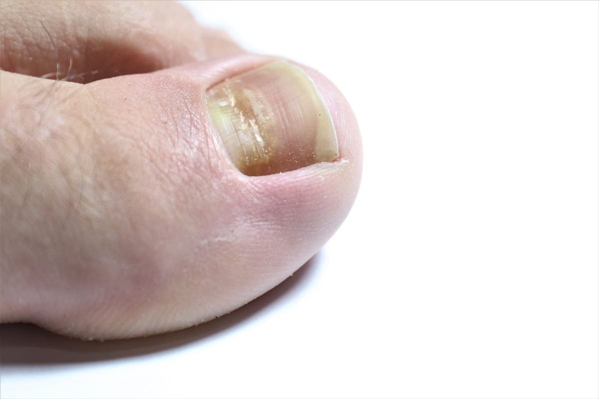 看「指甲」也能先快篩！新冠肺炎「指甲４症狀」，染疫過會出現白色條紋、指甲脫落特徵