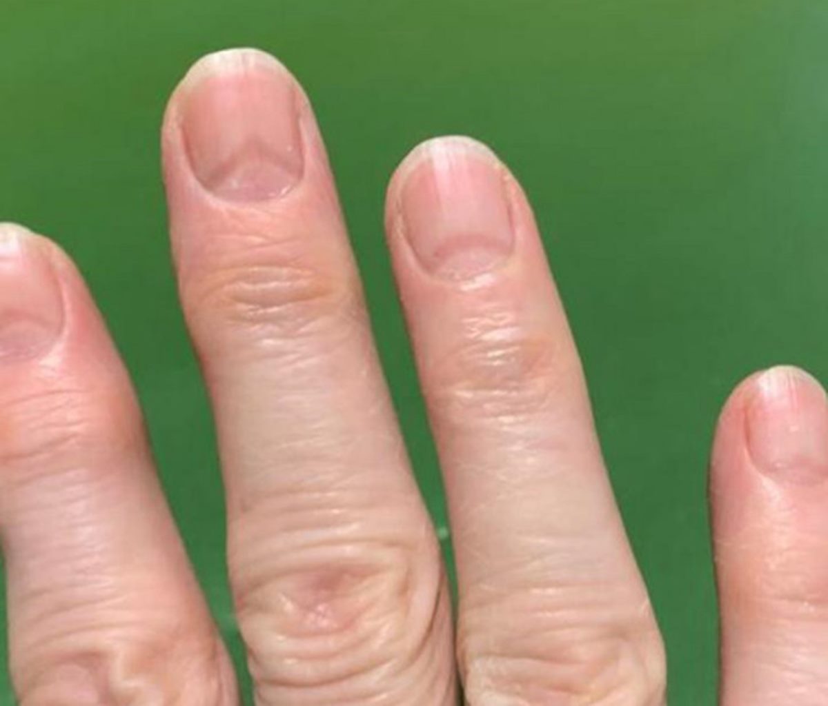 看「指甲」也能先快篩！新冠肺炎「指甲４症狀」，染疫過會出現白色條紋、指甲脫落特徵