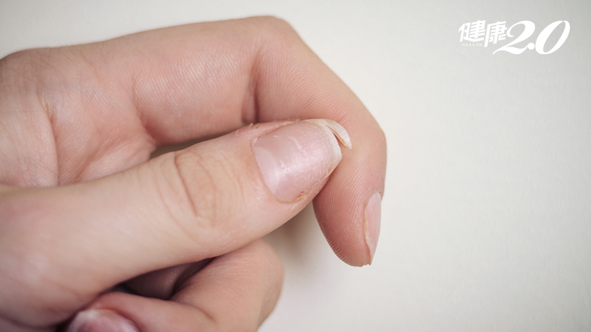指甲易裂是缺鈣？5種「指甲異常」暗示你營養不良！營養師教你怎麼補