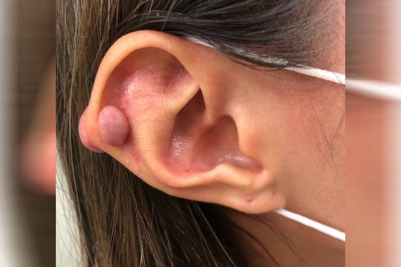 女大生「打耳洞竟長2顆大肉瘤」！醫師曝：那些人最容易有「蟹足腫體質」