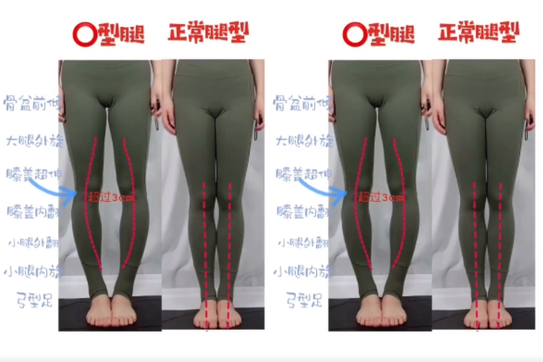 怎麼做才能改善「O型腿」？每天８分鐘！６招矯正＋美化腿形，運動白癡也能上手 