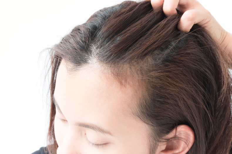 髮際線倒退嚕？３原因導致你加速掉髮！正常掉髮量超過「這數字」就要小心