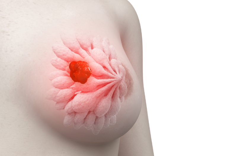 40＋女生是乳癌好發群！乳房出現「葉狀瘤」不能拖，胸部自我檢查法快學起來