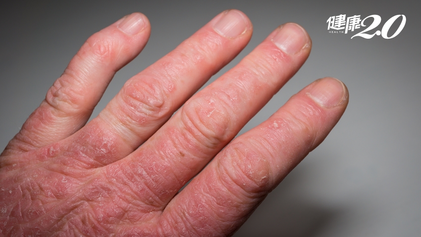 指關節腫痛如「香腸」原來是乾癬性關節炎！ 足底筋膜炎也是常見症狀