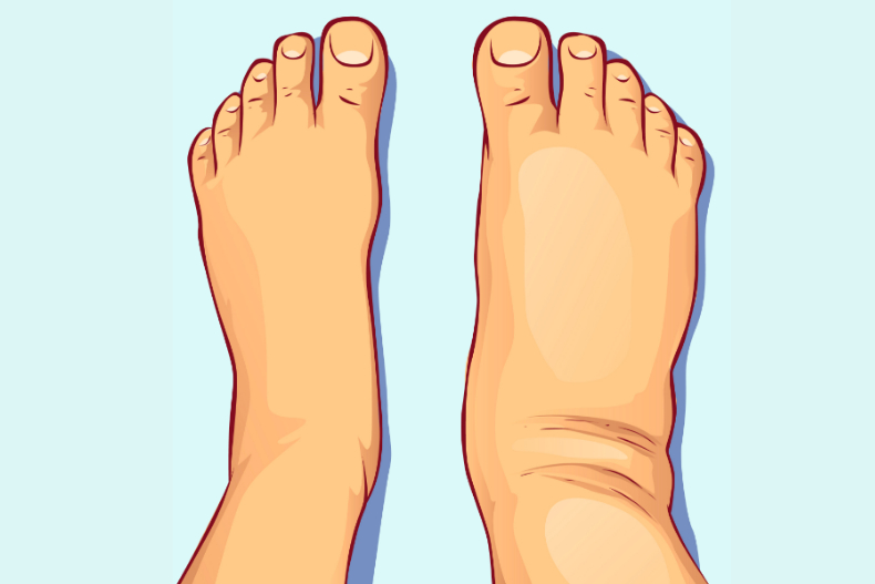 不能當沒事！水腫分４等級，醫提醒：「雙腳都腫」是身體６器官出問題