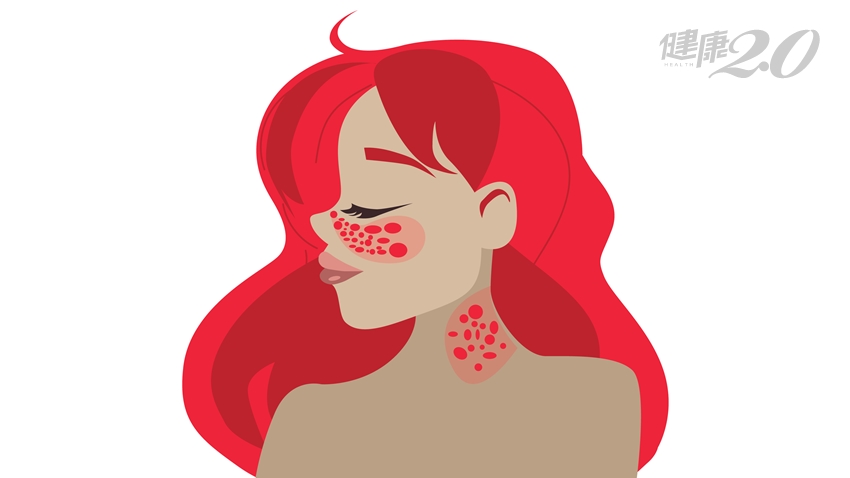 9成紅斑狼瘡是女性 關鍵致病因子找到了！