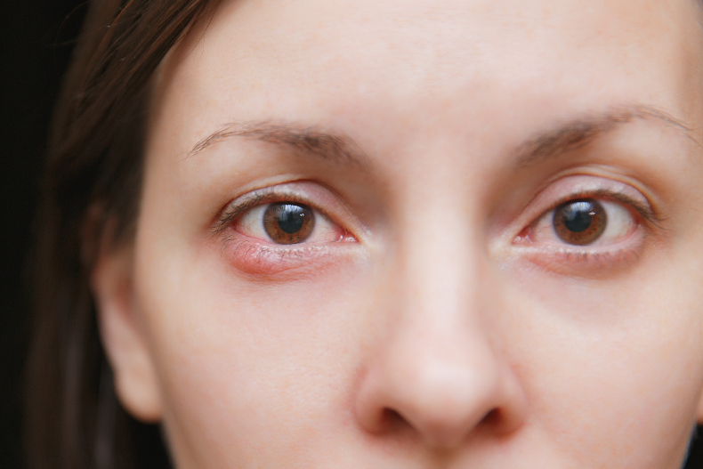 ▲長針眼是眼瞼皮脂腺發生堵塞