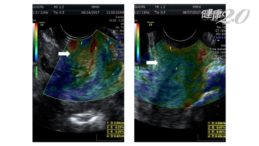 11個寶寶1個早產 馬偕研發「超音波彈性成像」，預測子宮頸、降低早產風險