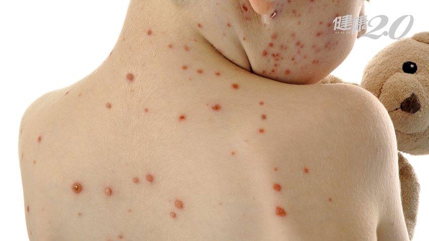 北市某大學發生水痘群聚感染 專家提醒4種人較容易得 出現紅疹、水泡要小心
