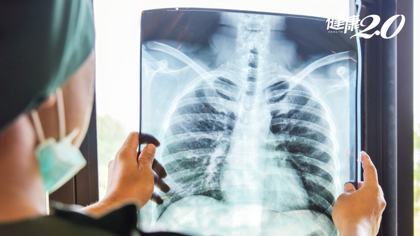 肺癌診斷大躍進！成大AI科技用X光片、免花錢做低劑量斷層掃瞄即可偵測肺癌