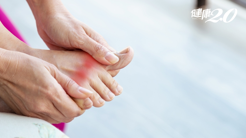 沒扭到腳還是超痛！醫曝更年期後女性痛風發生機率大增