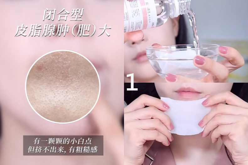 下巴滿滿白色小顆粒！韓國皮膚科醫師：學會2招「敷膜」秘訣，3步驟就能簡單清除