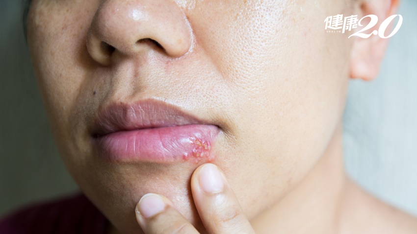 嘴巴長水泡「唇皰疹」會傳染？吃B群能改善？醫曝5危險因子，1招預防發作