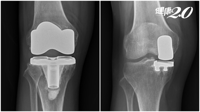膝關節全壞才能換？醫：膝蓋壞一半換一半 痛得少 好更快