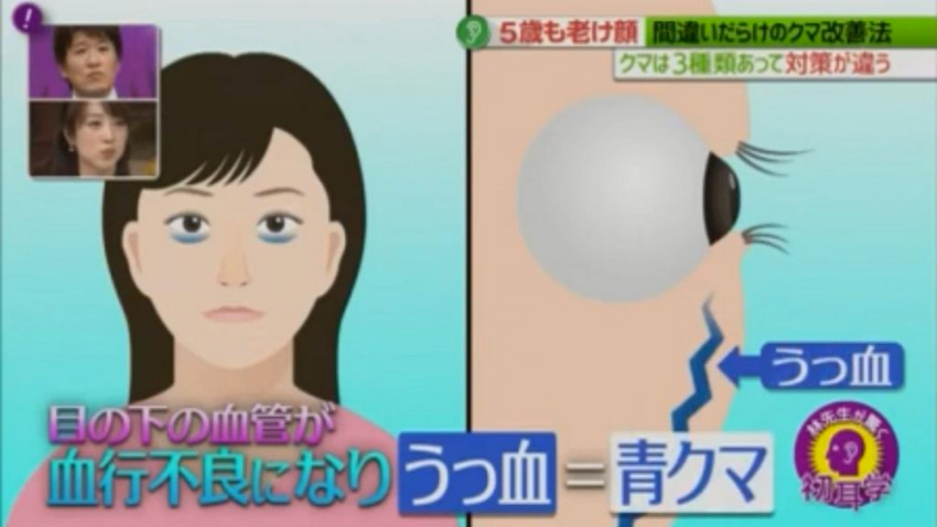消除黑眼圈只要1條毛巾，10分鐘就搞定！日本醫美醫師秀除黑眼圈3絕招