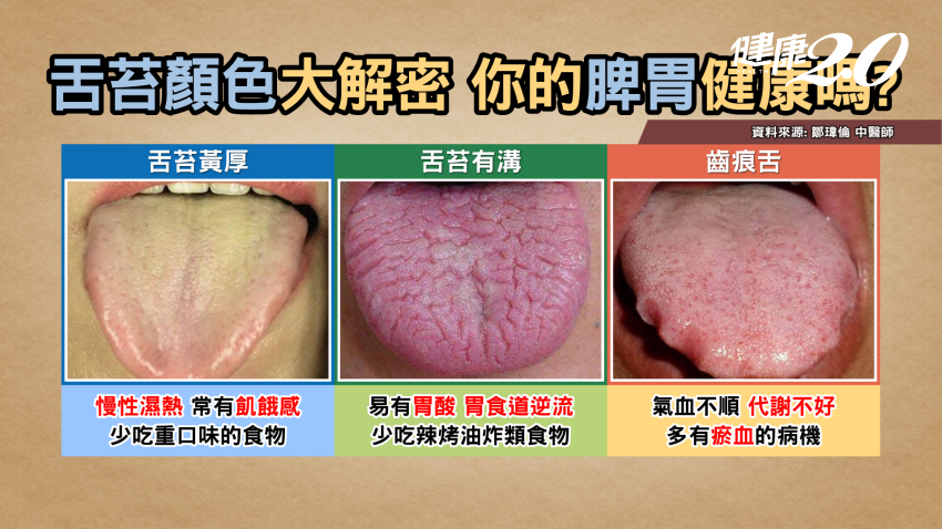 這種胸痛竟是胃癌前兆！快檢查舌苔顏色和舌頭形狀，「荷葉邊」舌頭當心