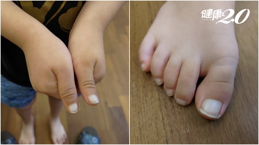 7歲童染疫退燒後一夕間手腳指甲全變白！醫曝免疫引爆小血栓，後續要追蹤2症狀