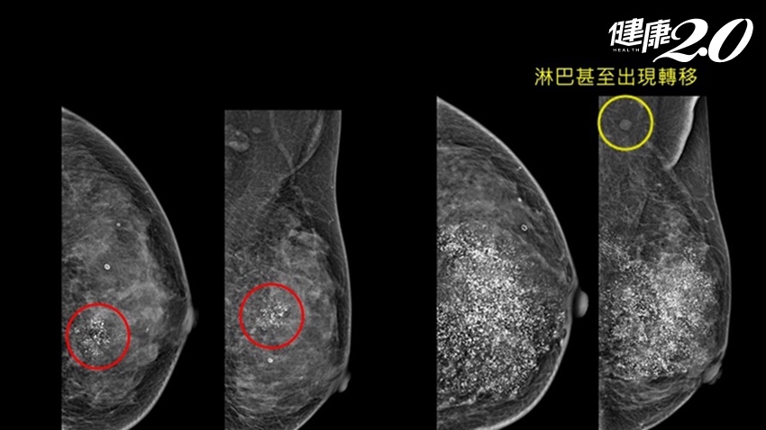 婦人罹癌怕治療拖2年 回診醫師大驚：乳房裡面像在下大雪