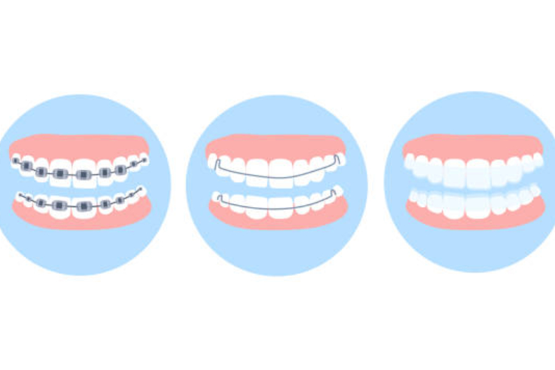 牙醫解答10大牙套常見QA：誰適合隱形牙套？傳統金屬、陶瓷哪個好？一定要拔牙嗎？
