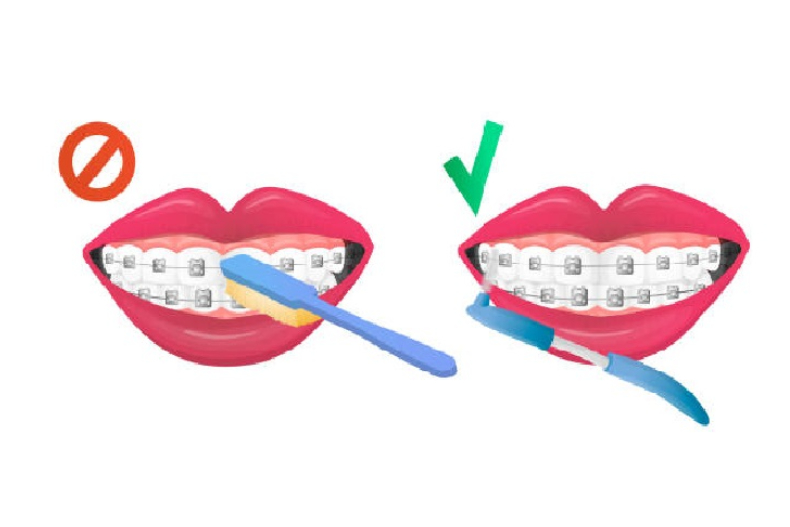 牙醫解答10大牙套常見QA：誰適合隱形牙套？傳統金屬、陶瓷哪個好？一定要拔牙嗎？