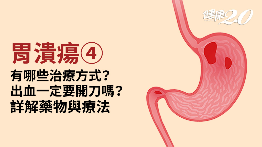 胃潰瘍／療程需要多久？哪種藥物最有效？1種療法有效根除幽門螺旋桿菌