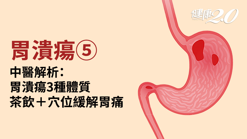 胃潰瘍／胃不好體質有3種！中醫保護胃黏膜：3個顧胃奇穴＋保健茶