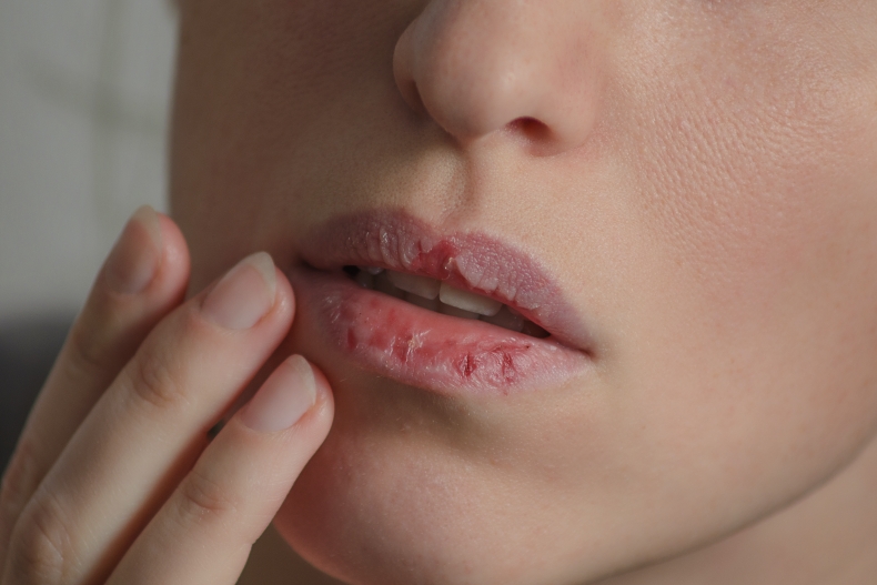 乾唇人必看！5個日常保養預防嘴唇乾裂死皮，護唇膏成分這樣挑才有效！
