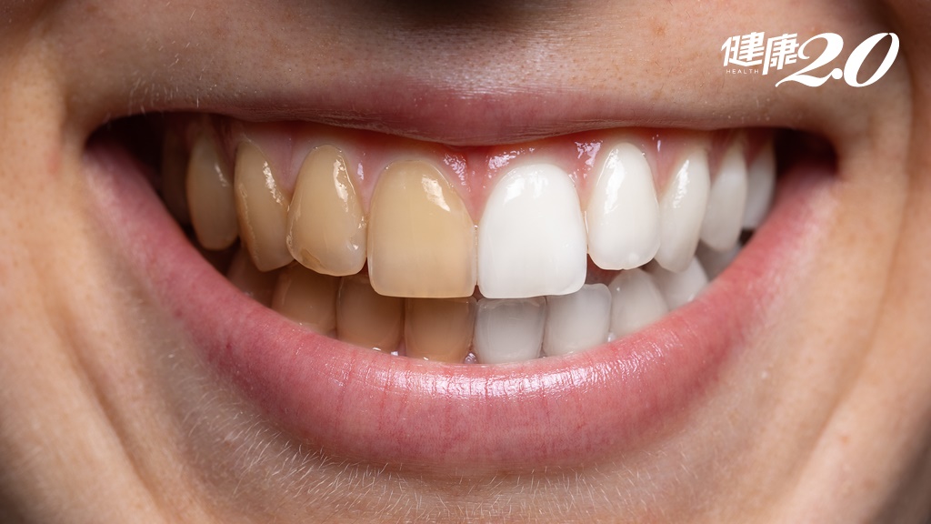 造成牙漬、牙齒染色的7種水果！牙醫師教你避免滿口黃牙 5種美齒食物快補充