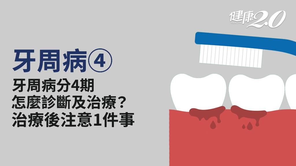 牙周病／牙周病能根治嗎？如何診斷及治療？治療後1件事絕不可輕忽