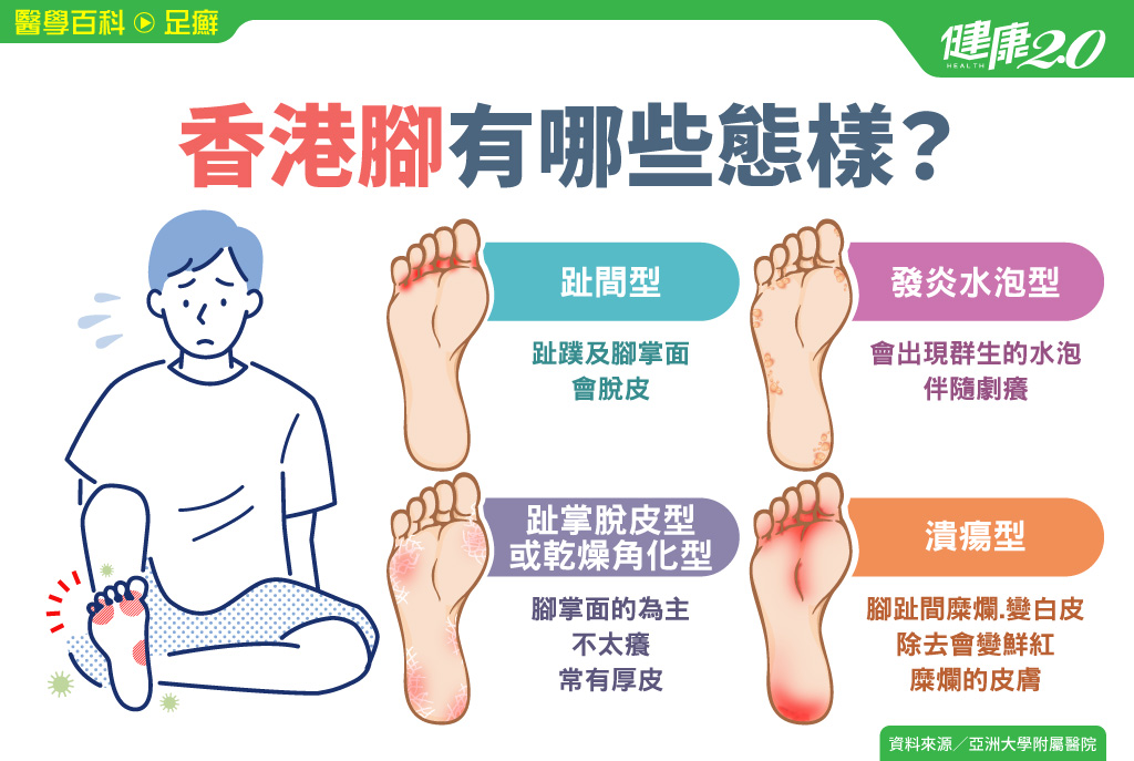 足癬／為什麼會得香港腳？症狀不只發癢、長水泡 4種類型告訴你