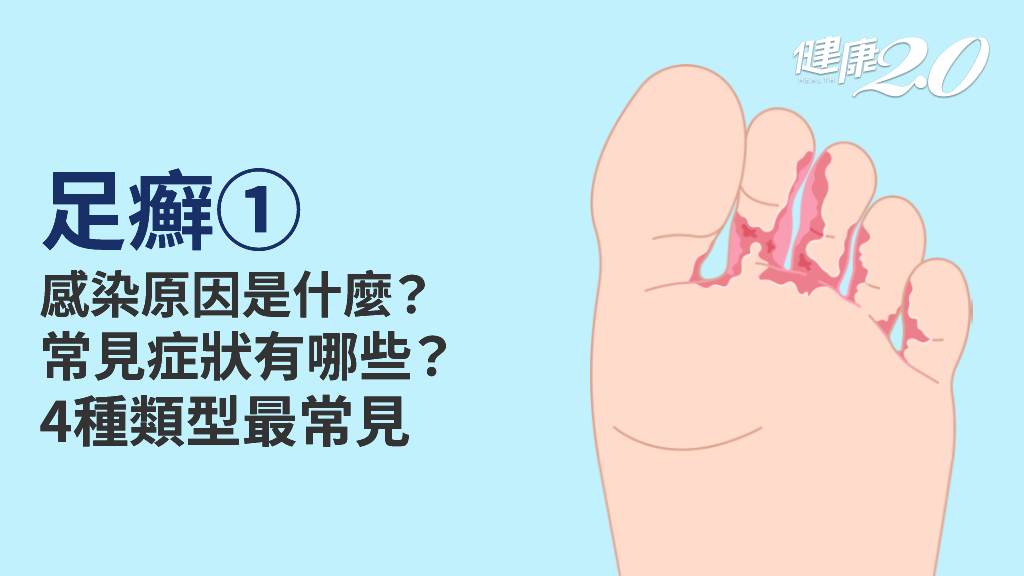 足癬／為什麼會得香港腳？症狀不只發癢、長水泡 4種類型告訴你