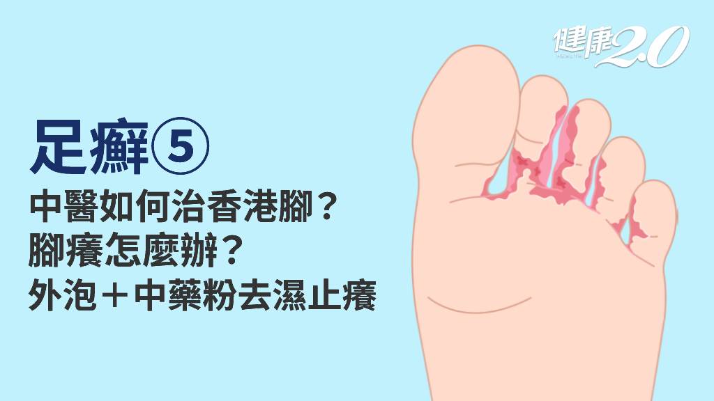 足癬／中醫怎麼治療香港腳？「外洗方」去濕促循環 3款中藥粉抗菌又止癢
