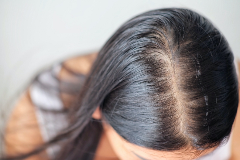 頭髮狂掉怎麼辦？4種常見落髮原因，這情況的掉髮竟不可逆？