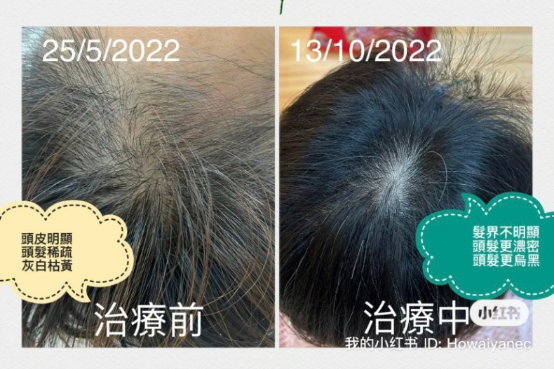 60＋白髮轉黑真的可以！中醫師分享「合補腎烏髮茶」＋2種調理方式，頭髮變黑還瘋長
