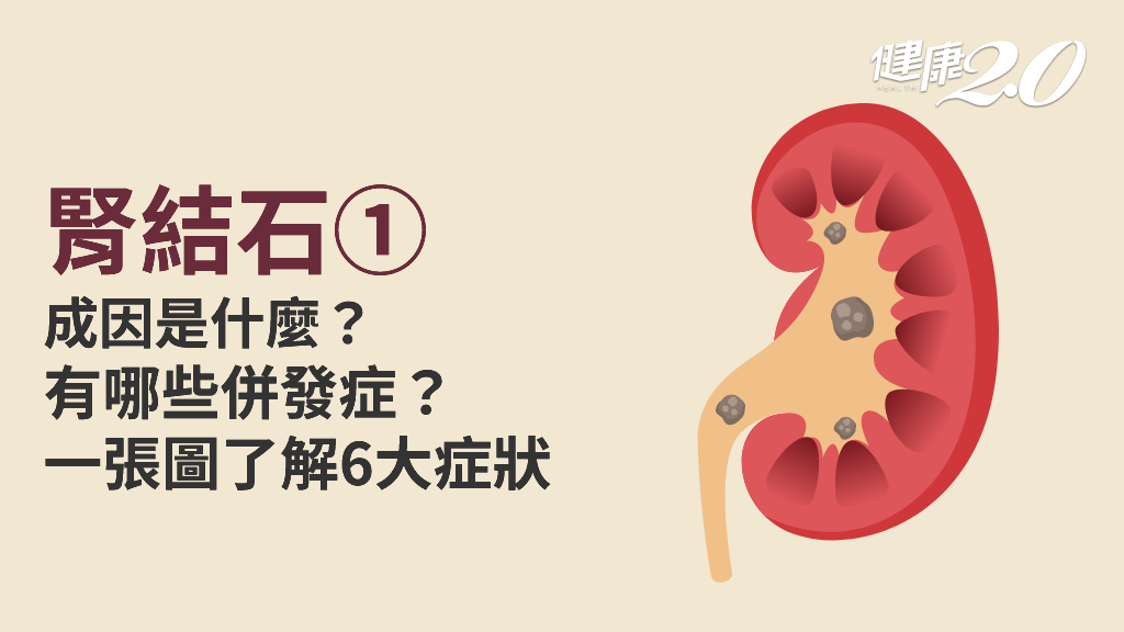 腎結石／為什麼會發生腎結石？腎結石有哪些症狀？當心腎衰竭要洗腎