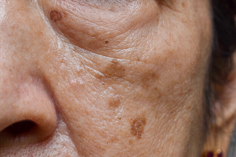 18歲就長老人斑！皮膚科醫師曝：各種年齡層都會發生！親解老人斑成因與搶救對策