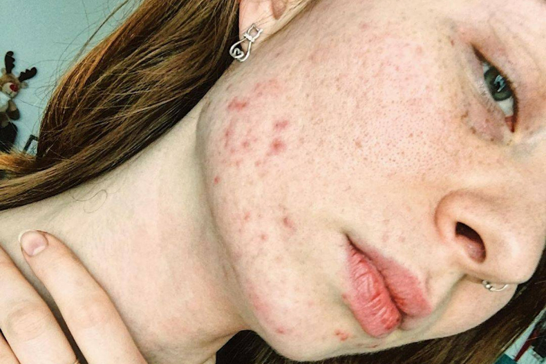 花10萬救暗瘡爛臉卻更糟！英國化妝師親授7個低成本抗痘法，成功救回皮膚