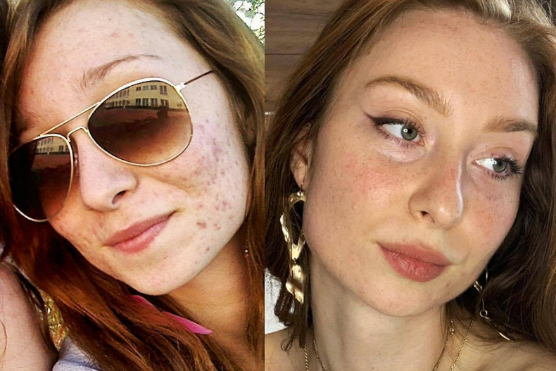 花10萬救暗瘡爛臉卻更糟！英國化妝師親授7個低成本抗痘法，成功救回皮膚