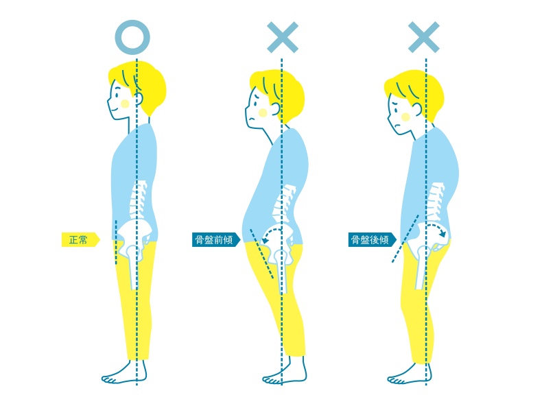 骨盆前傾導致下盤肥大、小腹凸？4招骨盆前傾自我矯正在家就能做！