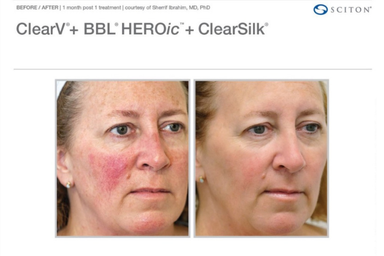 金卡戴珊鏡頭下的透亮肌秘密曝光：名媛圈瘋BBL HEROic 煥新光自帶光感不上濾鏡！
